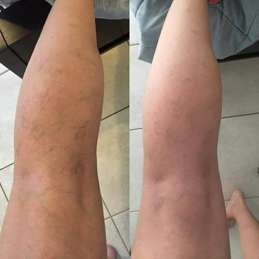 VariCream - Crema reductora de varices, para dolor y piernas hinchadas