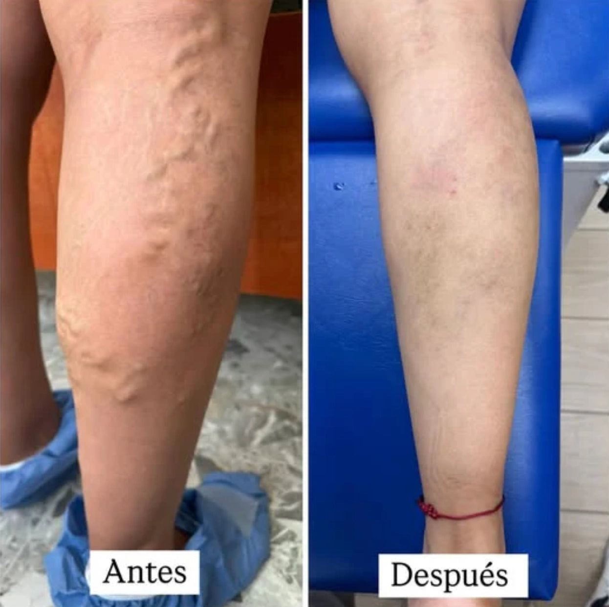 VenaFlow™ - Medias de Compresión para Neuropatía y Várices 2 X 1