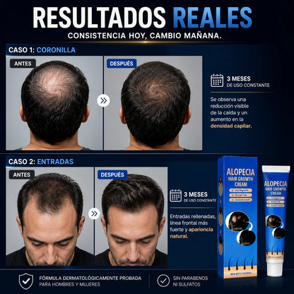 AlopeCacia™ - Tratamiento para Alopecia y Calvicie