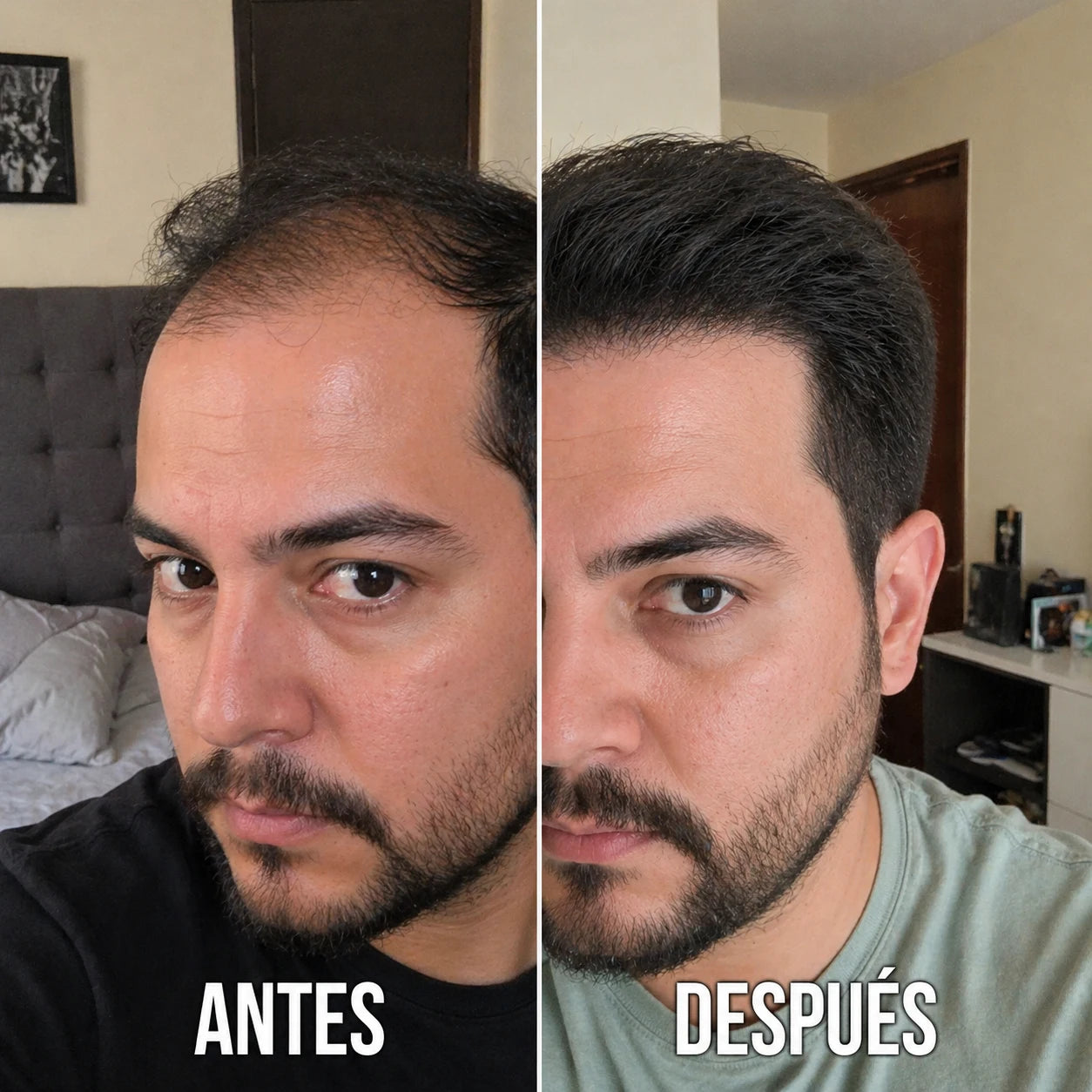 AlopeCacia™ - Tratamiento para Alopecia y Calvicie