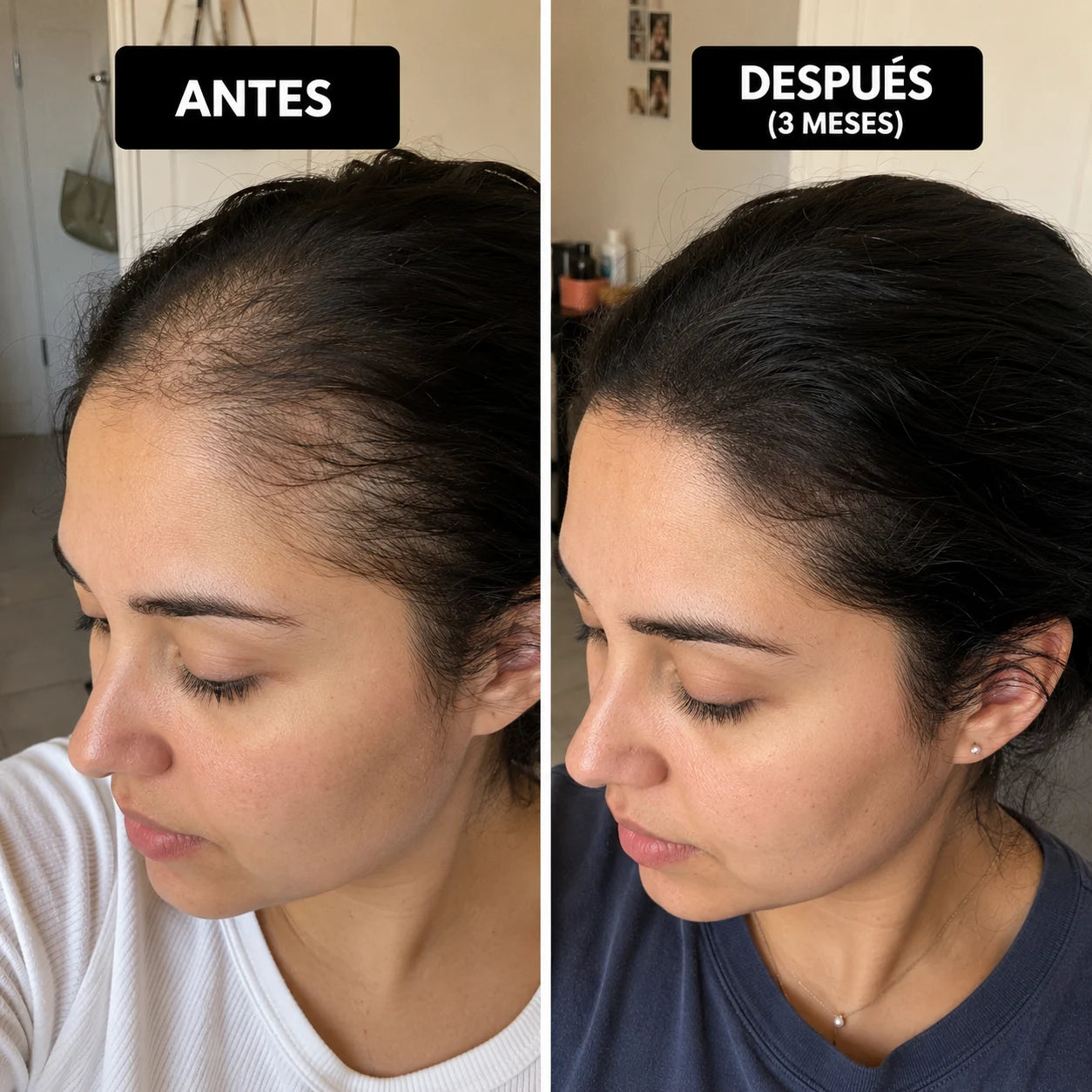 AlopeCacia™ - Tratamiento para Alopecia y Calvicie