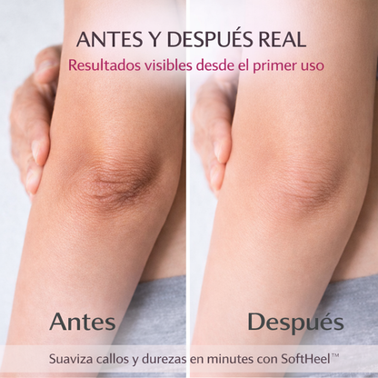 SoftHeel™ – Kit Removedor de Callos y Piel Muerta 🦶🏼