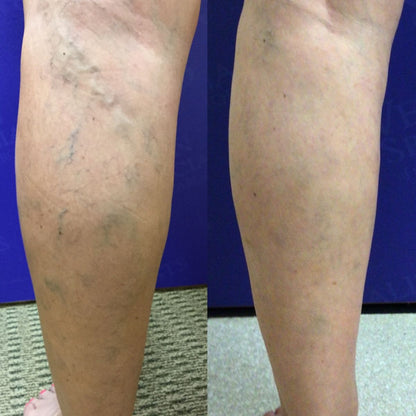 VariCream - Crema reductora de varices, para dolor y piernas hinchadas